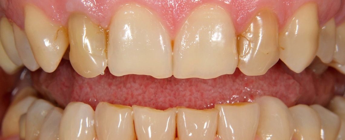 Composite Bonding and Whitening Before