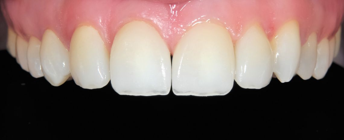 Fast braces | Southampton | Titchfield Dental Health
